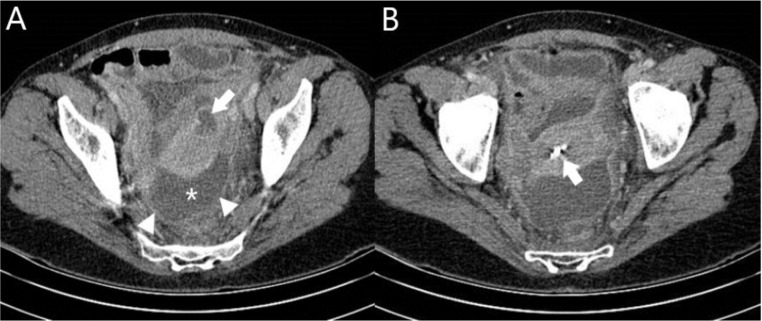 Bacteremia caused by Eikenella corrodens in a patient with pelvic inflammatory disease.