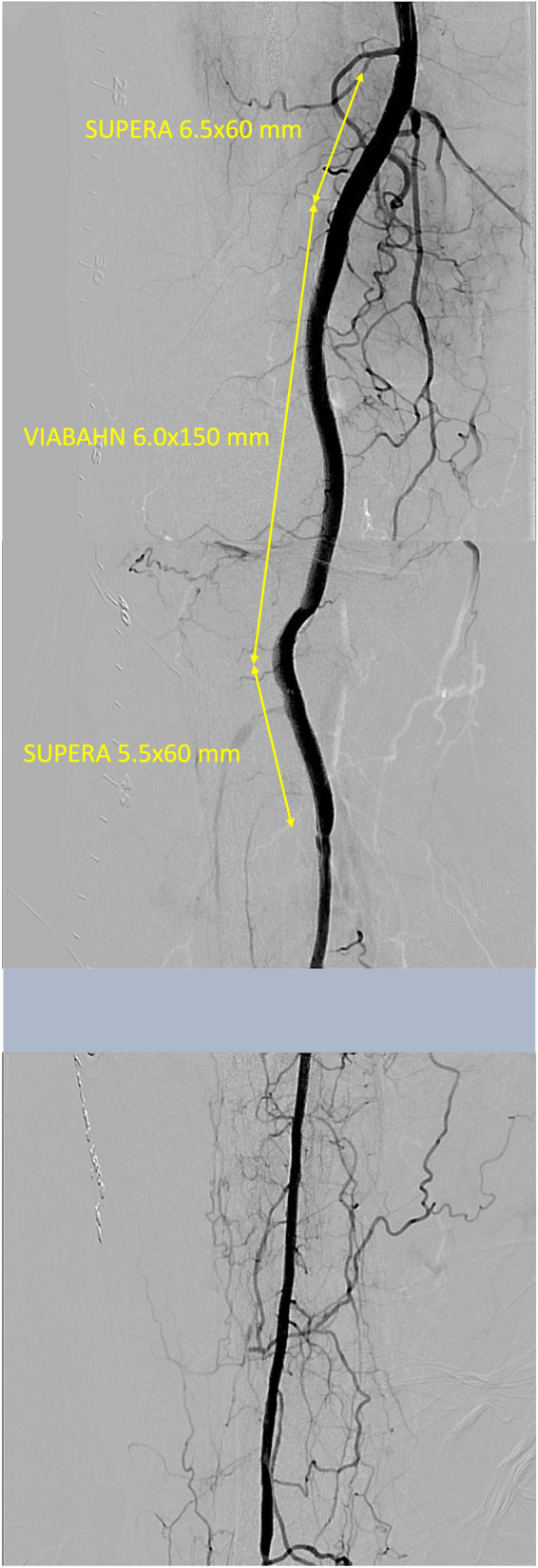 A case of chronic total occlusion in popliteal artery recanalized by double snare piercing technique.