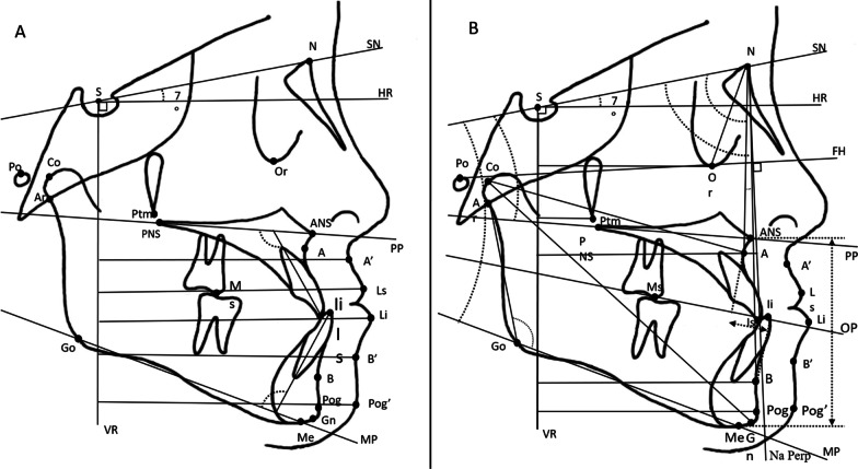 Dentofacial effects of miniscrew-anchored maxillary protraction on prepubertal children with maxillary deficiency: a randomized controlled trial.