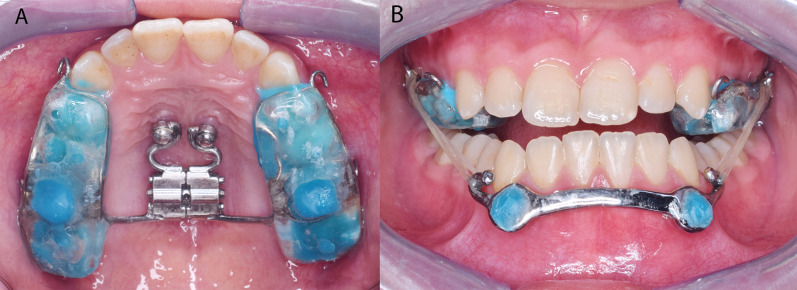 Dentofacial effects of miniscrew-anchored maxillary protraction on prepubertal children with maxillary deficiency: a randomized controlled trial.