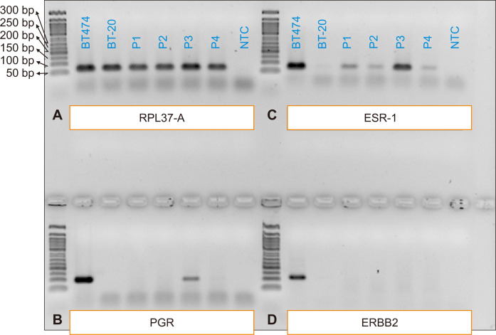 Immunohistochemistry versus PCR Technology for Molecular Subtyping of Breast Cancer: Multicentered Expereinces from Addis Ababa, Ethiopia.