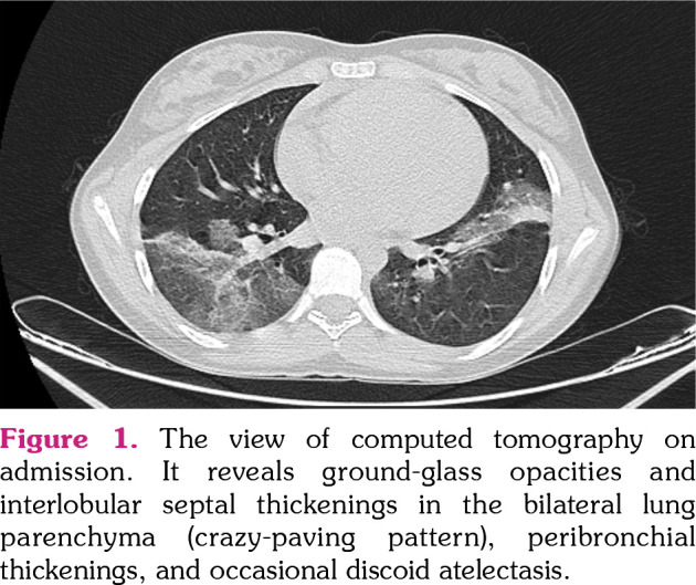 Mepolizumab therapy in a pediatric patient with eosinophilic granulomatosis with polyangiitis associated with refractory myocarditis.