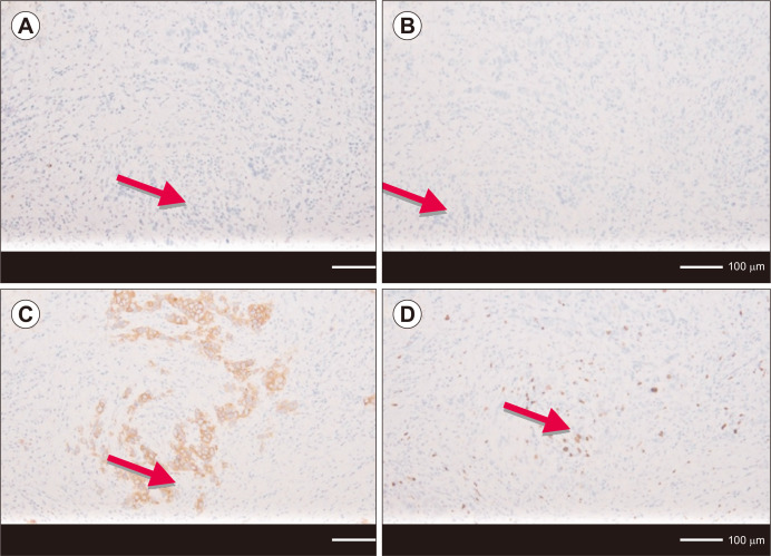 Immunohistochemistry versus PCR Technology for Molecular Subtyping of Breast Cancer: Multicentered Expereinces from Addis Ababa, Ethiopia.