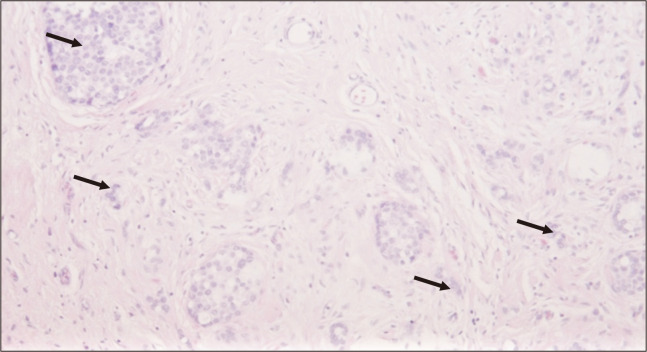 Immunohistochemistry versus PCR Technology for Molecular Subtyping of Breast Cancer: Multicentered Expereinces from Addis Ababa, Ethiopia.