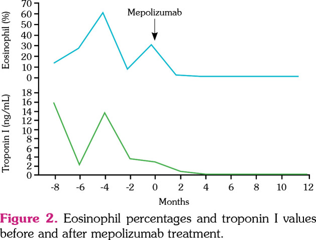 Mepolizumab therapy in a pediatric patient with eosinophilic granulomatosis with polyangiitis associated with refractory myocarditis.