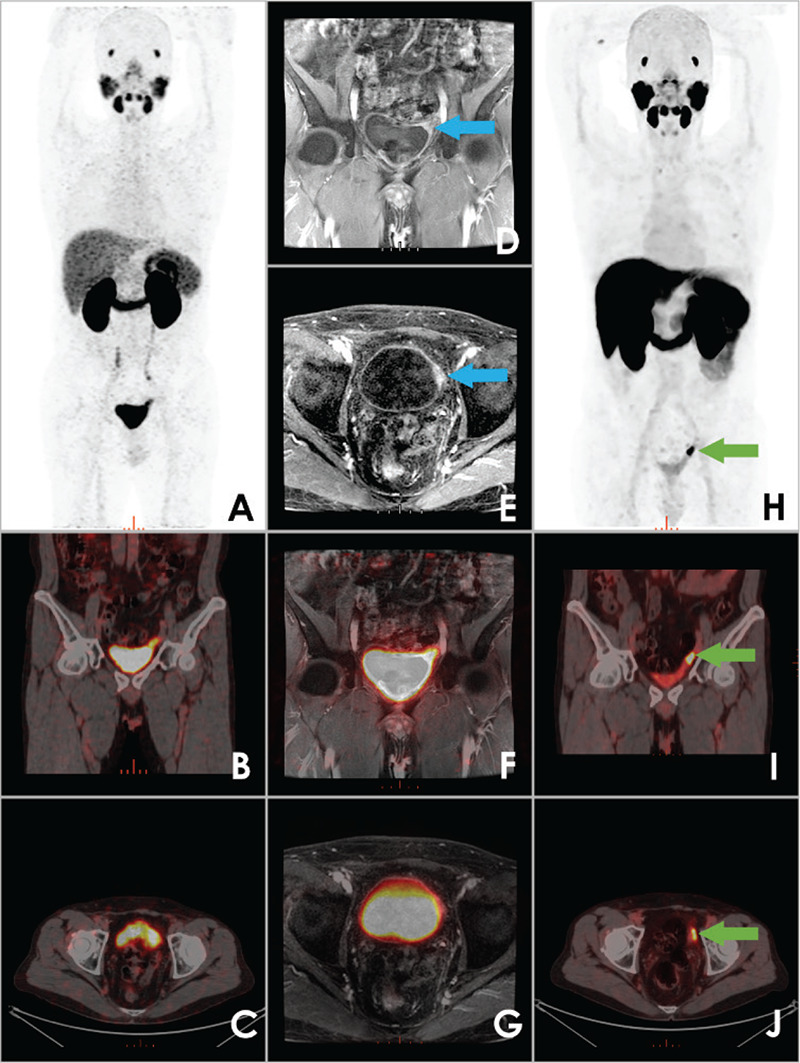 Comparison of <sup>68</sup>Ga-PSMA PET/CT and <sup>18</sup>F-PSMA PET/CT of a Patient with Prostate Cancer Recurrence on Urinary Bladder Wall.