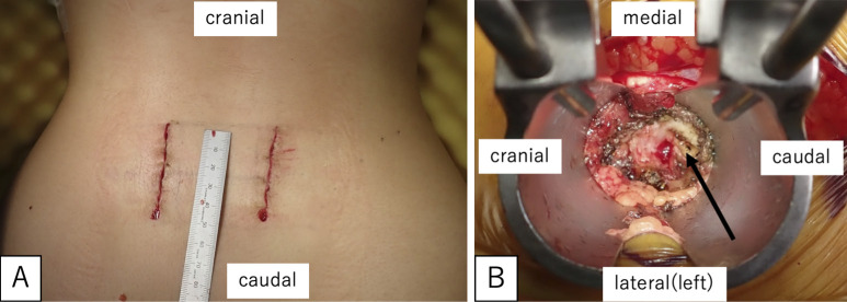 A Novel Technique for Pars Defect Direct Repair with a Modified Smiley Face Rod for Spondylolysis and Isthmic Spondylolisthesis.