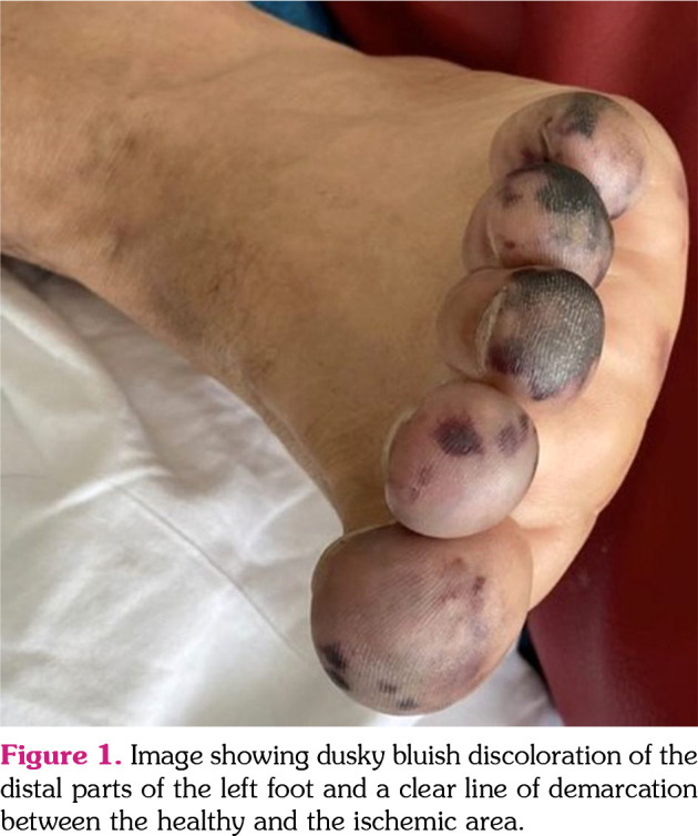 COVID-19-induced digital ischemia in antiphospholipid syndrome.