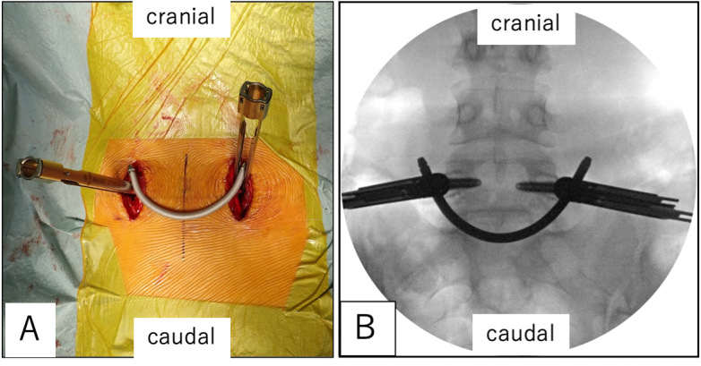 A Novel Technique for Pars Defect Direct Repair with a Modified Smiley Face Rod for Spondylolysis and Isthmic Spondylolisthesis.