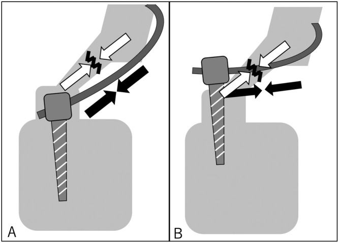 A Novel Technique for Pars Defect Direct Repair with a Modified Smiley Face Rod for Spondylolysis and Isthmic Spondylolisthesis.