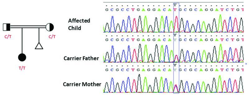 <i>PMM2</i> -CDG T237M Mutation in a Patient with Cerebral Palsy-Like Phenotypes Reported from South India.