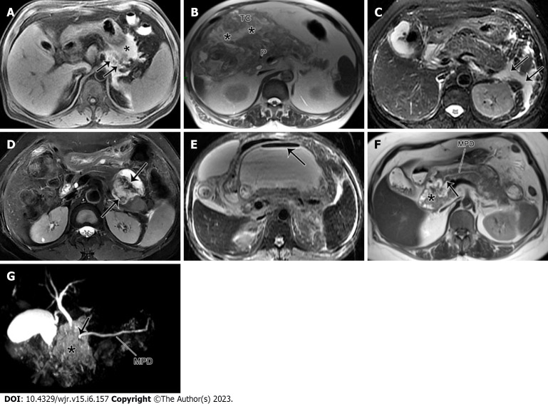 Acute pancreatitis: Structured report template of magnetic resonance imaging.