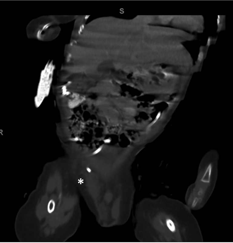 Cerebrospinal Fluid Leakage from Scrotum Secondary to Ventriculoperitoneal Shunt Migration.