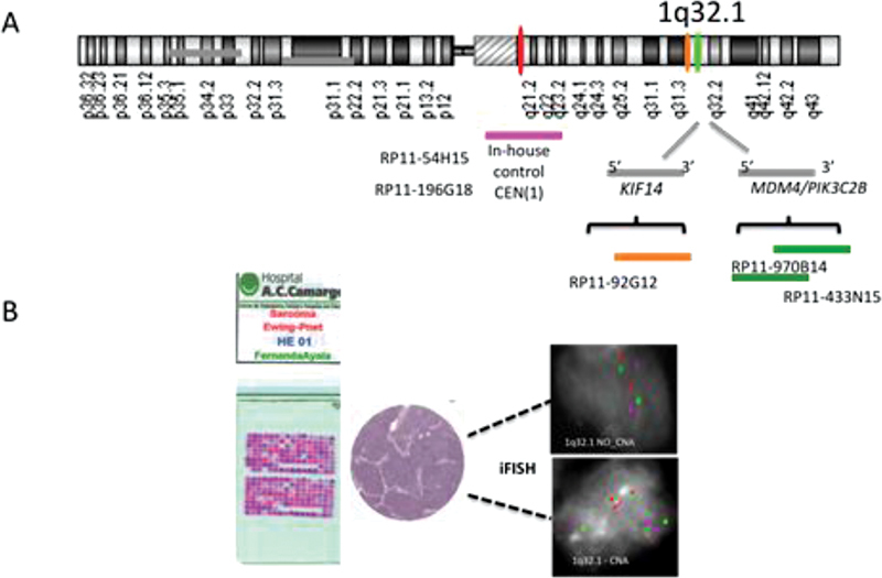 Replication Timing Aberration of <i>KIF14</i> and <i>MDM4</i> / <b><i>PI3KC</i></b> 2 <i>β</i> Alleles and Aneuploidy as Markers of Chromosomal Instability and Poor Treatment Response in Ewing Family Tumor Patients.