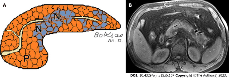 Acute pancreatitis: Structured report template of magnetic resonance imaging.