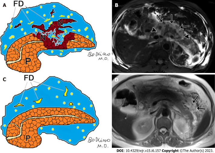 Acute pancreatitis: Structured report template of magnetic resonance imaging.