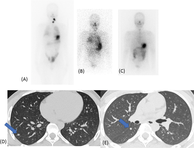 Assessment of Pulmonary Metastasis in Differentiated Thyroid Carcinoma: Value of HRCT Correlation with Functional Imaging.