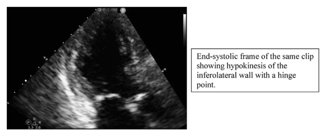 Syncope as the Sole Presentation of Multi-Vessel Coronary Artery Disease.