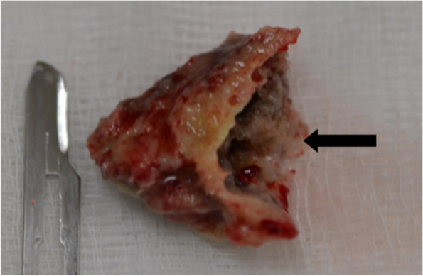 Denosumab-associated jaw bone necrosis in cancer patients: retrospective descriptive case series study.