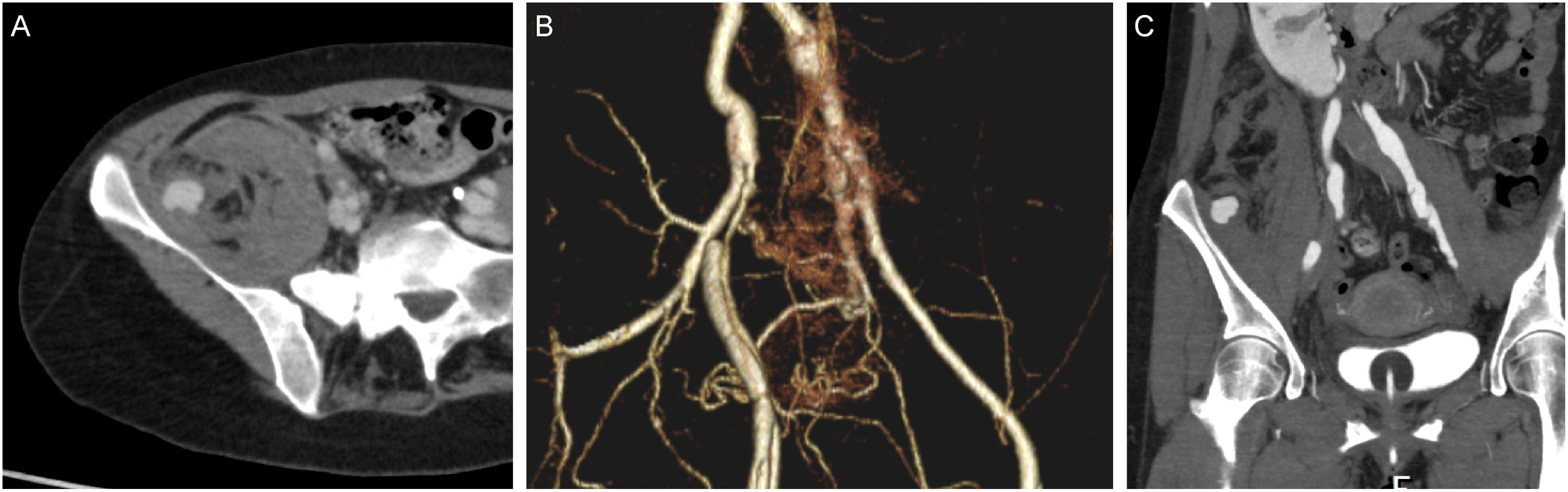 Improvement in Quality of Life Following Celiprolol Hydrochloride Administration in a Patient with Vascular Ehlers-Danlos Syndrome: A Case Report.