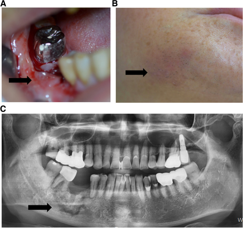 Denosumab-associated jaw bone necrosis in cancer patients: retrospective descriptive case series study.