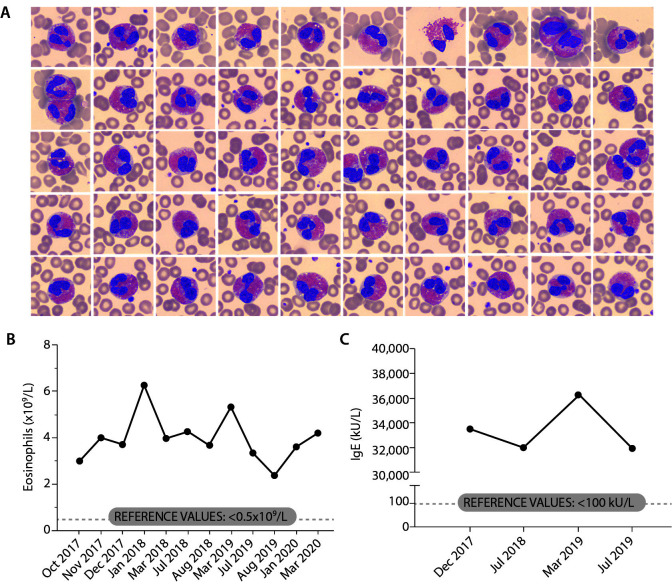 Kimura disease as an uncommon cause of persistent hypereosinophilia: a diagnostic challenge.