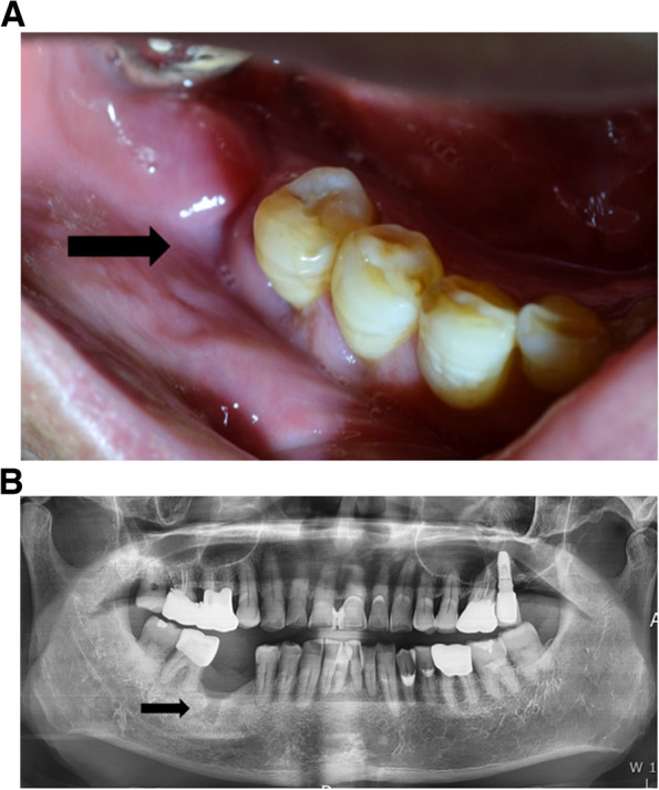 Denosumab-associated jaw bone necrosis in cancer patients: retrospective descriptive case series study.