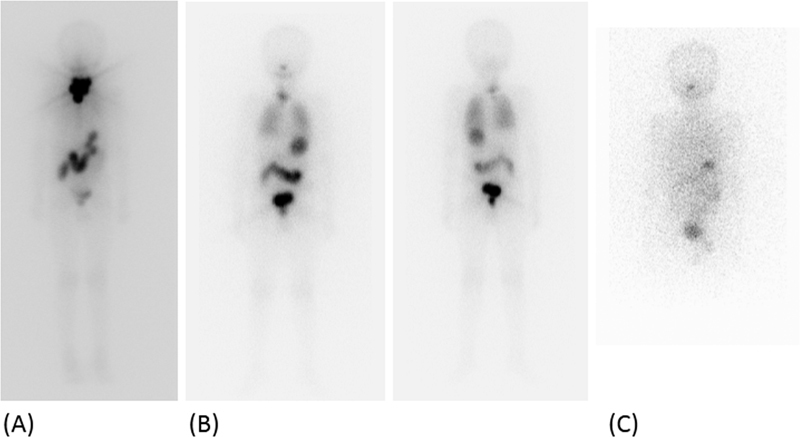 Assessment of Pulmonary Metastasis in Differentiated Thyroid Carcinoma: Value of HRCT Correlation with Functional Imaging.