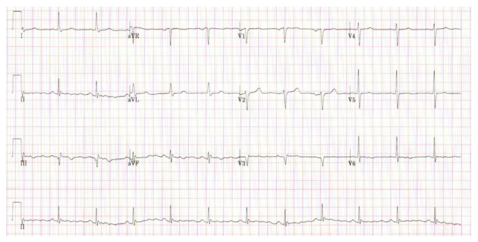 Syncope as the Sole Presentation of Multi-Vessel Coronary Artery Disease.