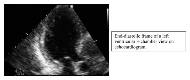 Syncope as the Sole Presentation of Multi-Vessel Coronary Artery Disease.