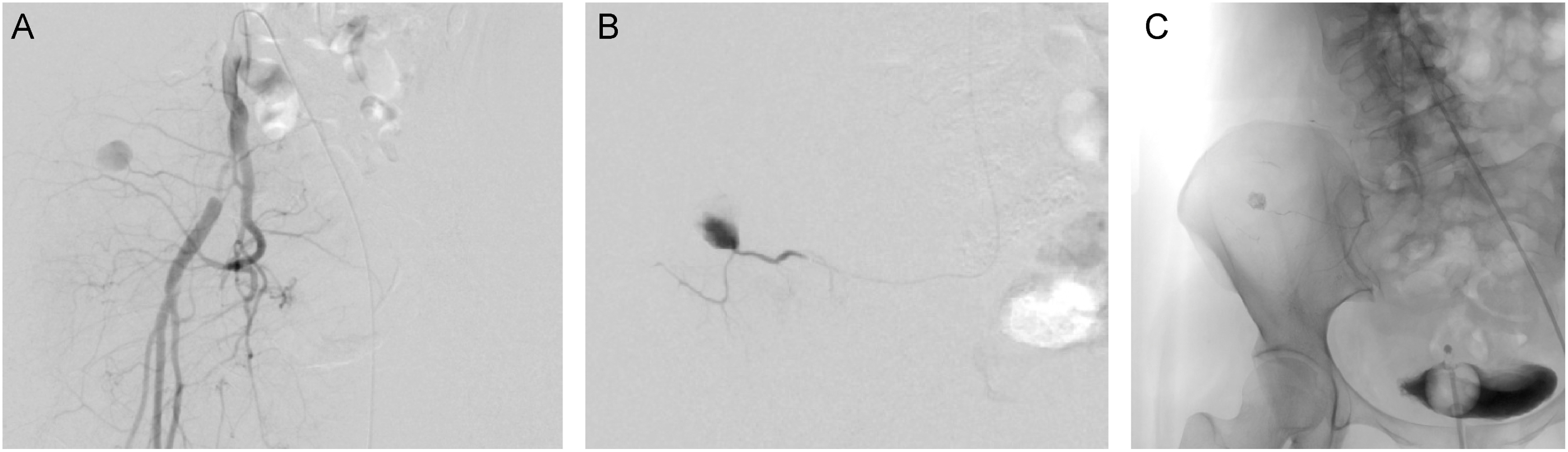 Improvement in Quality of Life Following Celiprolol Hydrochloride Administration in a Patient with Vascular Ehlers-Danlos Syndrome: A Case Report.