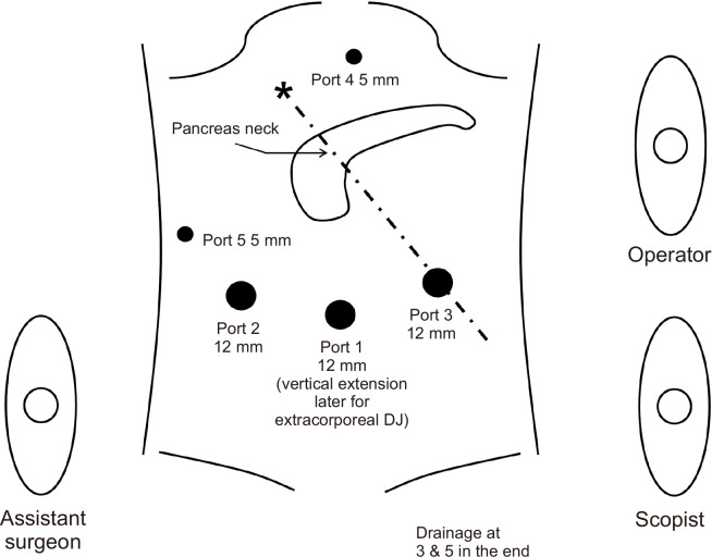 Laparoscopic pancreaticoduodenectomy and laparoscopic pancreaticoduodenectomy with robotic reconstruction: single-surgeon experience and technical notes.