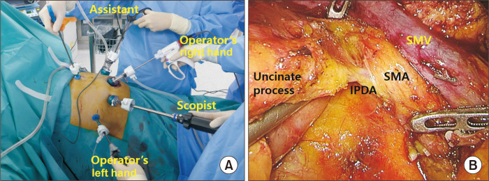 Laparoscopic pancreaticoduodenectomy and laparoscopic pancreaticoduodenectomy with robotic reconstruction: single-surgeon experience and technical notes.