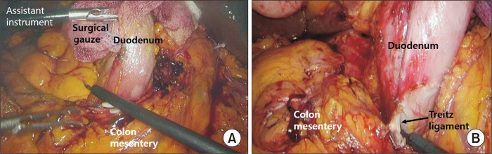 Laparoscopic pancreaticoduodenectomy and laparoscopic pancreaticoduodenectomy with robotic reconstruction: single-surgeon experience and technical notes.