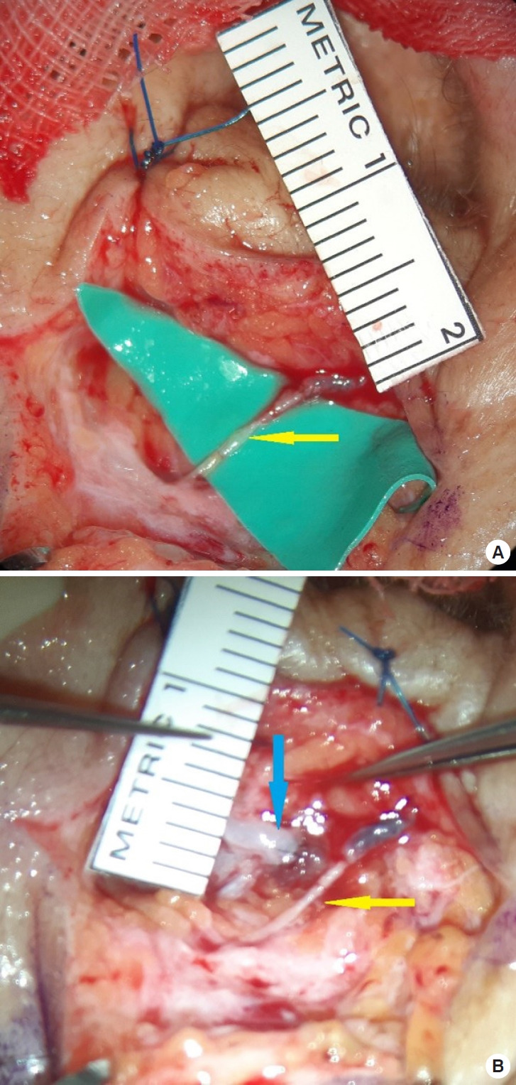 Lymphaticovenular anastomosis for Morbihan disease: a case report.