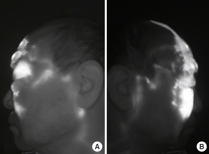 Lymphaticovenular anastomosis for Morbihan disease: a case report.