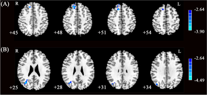 Altered intrinsic functional network connectivity is associated with impulsivity and emotion dysregulation in drug-naïve young patients with borderline personality disorder.