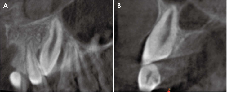 Cone-beam computed tomographic reconstructions in the evaluation of maxillary impacted canines.