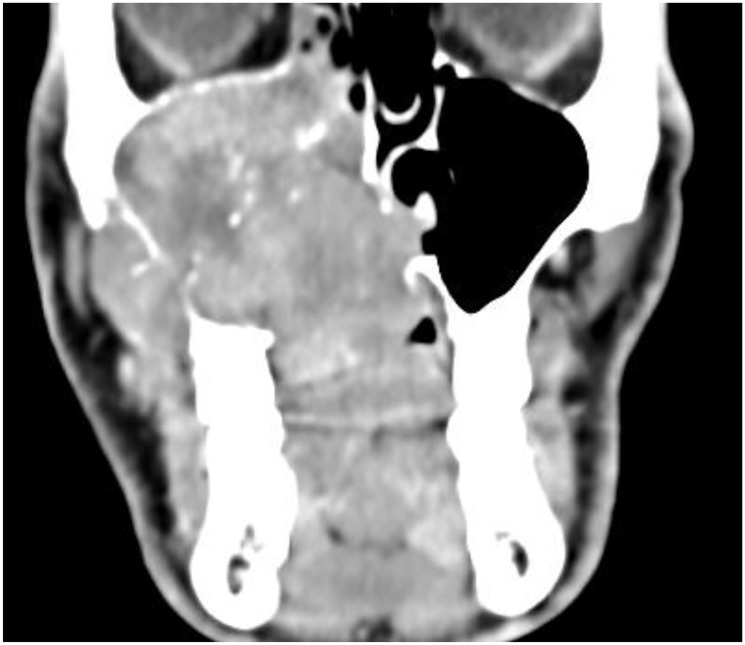 Adenoid cystic carcinoma of the head and neck - treatment strategies of a highly malignant tumor with variable localizations.