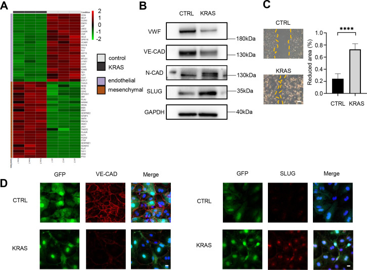 KRAS mutation-induced EndMT of brain arteriovenous malformation is mediated through the TGF-β/BMP-SMAD4 pathway.