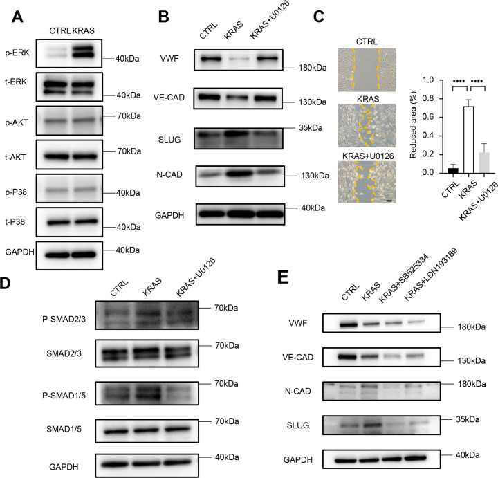 KRAS mutation-induced EndMT of brain arteriovenous malformation is mediated through the TGF-β/BMP-SMAD4 pathway.