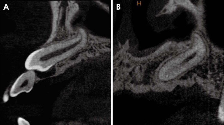 Cone-beam computed tomographic reconstructions in the evaluation of maxillary impacted canines.