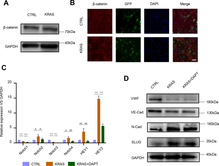 KRAS mutation-induced EndMT of brain arteriovenous malformation is mediated through the TGF-β/BMP-SMAD4 pathway.