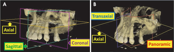 Cone-beam computed tomographic reconstructions in the evaluation of maxillary impacted canines.