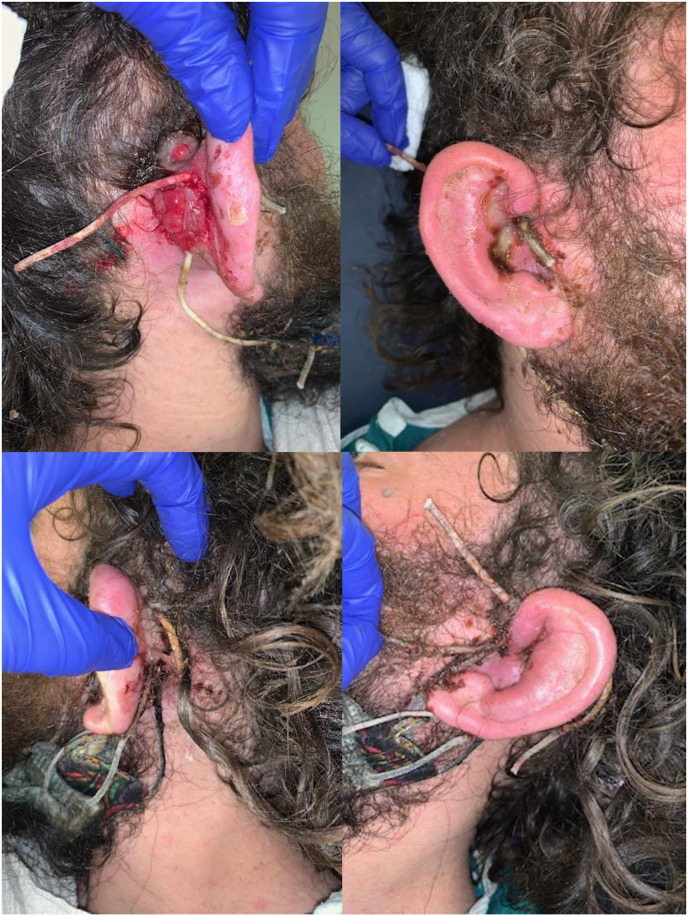 Wound healing in the vulnerable: A novel case of postauricular wounds caused by mask ties