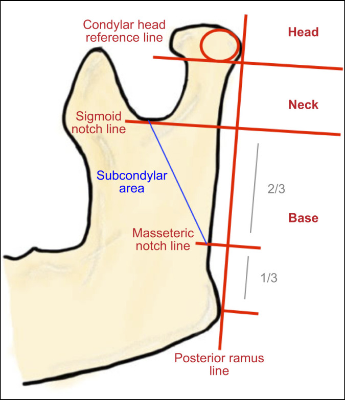 Management of Mandibular Condyle Fractures in Paediatric Patients: a Systematic Review.