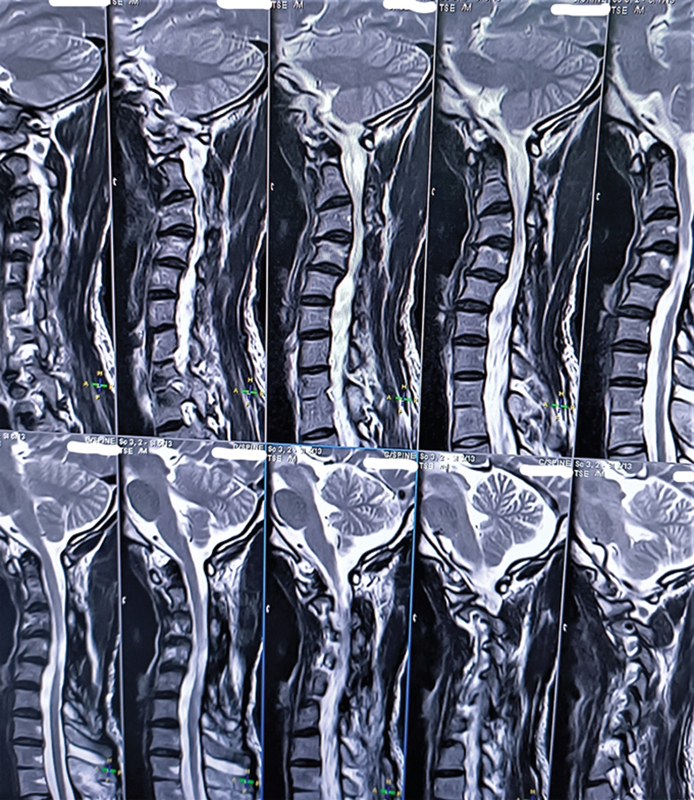 Cervical Trident-Shaped Neurofibroma: A Rare Variant.