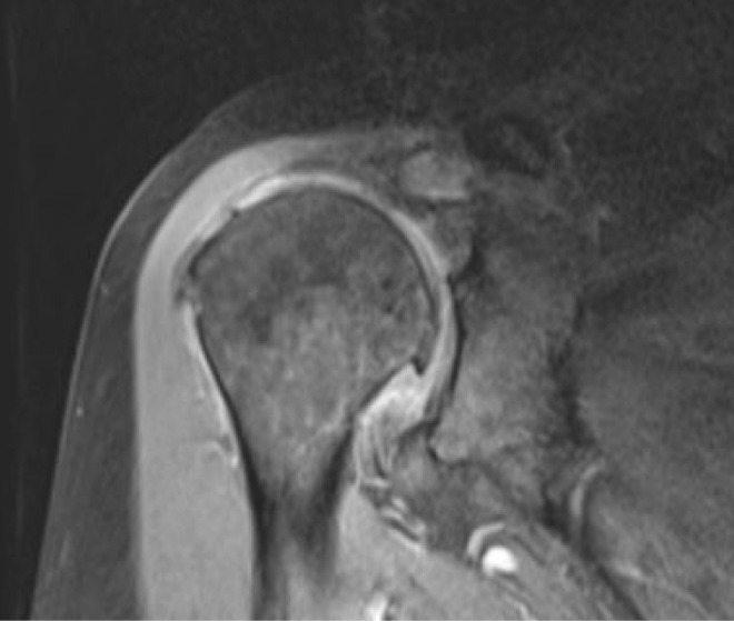 Chronic locked anterior shoulder dislocation with impaction of the humeral head onto the coracoid: a case report.