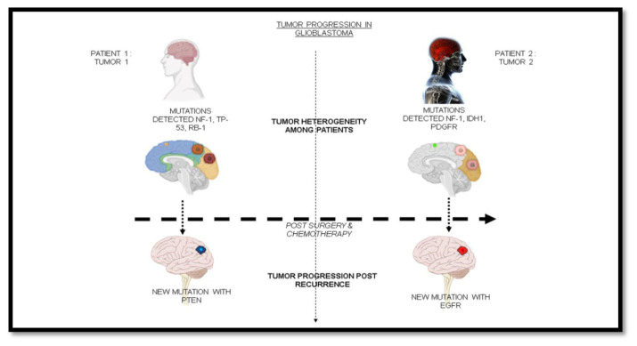 Precision medicine advancements in glioblastoma: A systematic review.