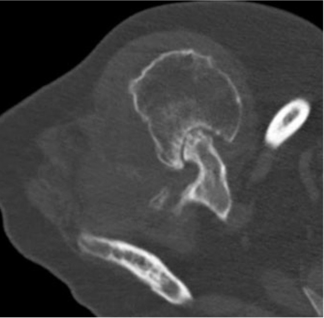 Chronic locked anterior shoulder dislocation with impaction of the humeral head onto the coracoid: a case report.